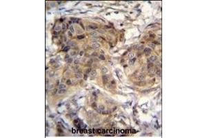 TTC9C Antibody (N-term) (ABIN655122 and ABIN2844752) immunohistochemistry analysis in formalin fixed and paraffin embedded human breast carcinoma followed by peroxidase conjugation of the secondary antibody and DAB staining.
