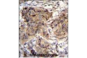 TTC9C Antibody (N-term) (ABIN655122 and ABIN2844752) immunohistochemistry analysis in formalin fixed and paraffin embedded human breast carcinoma followed by peroxidase conjugation of the secondary antibody and DAB staining. (TTC9C anticorps  (N-Term))