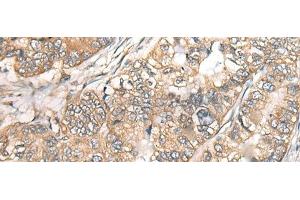 Immunohistochemistry of paraffin-embedded Human gastric cancer tissue using BCHE Polyclonal Antibody at dilution of 1:40(x200)