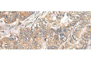 Immunohistochemistry of paraffin-embedded Human gastric cancer tissue using BCHE Polyclonal Antibody at dilution of 1:40(x200) (Butyrylcholinesterase anticorps)
