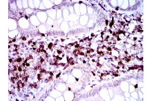 Immunohistochemical analysis of paraffin-embedded endometrial cancer tissues using CD7 mouse mAb with DAB staining.
