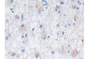 DAB staining on IHC-P; Samples: Human Glioma Tissue (Nestin anticorps  (AA 178-399))