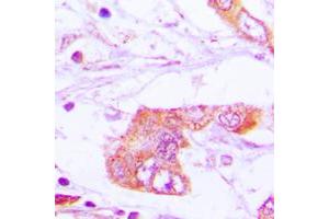 Immunohistochemical analysis of Apolipoprotein E staining in human lung cancer formalin fixed paraffin embedded tissue section.