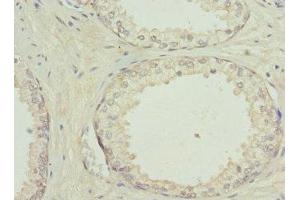 Immunohistochemistry of paraffin-embedded human prostate cancer using ABIN7154206 at dilution of 1:100
