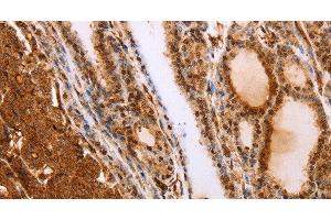 Immunohistochemistry of paraffin-embedded Human thyroid cancer tissue using SLC9A3R2 Polyclonal Antibody at dilution 1:40 (SLC9A3R2 anticorps)