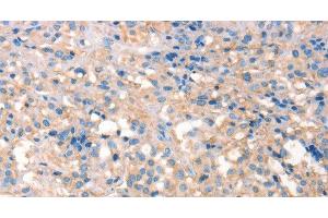 Immunohistochemistry of paraffin-embedded Human thyroid cancer using PRPS1/2/PRPS1L1 Polyclonal Antibody at dilution of 1:30 (PRPS1/2/1L1 anticorps)