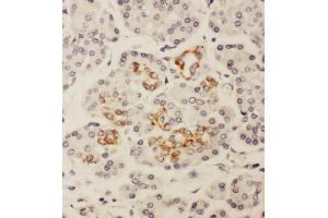Anti-HOXA3 antibody, IHC(P) IHC(P): Human Pancreatic Cancer Tissue (HOXA3 anticorps  (C-Term))