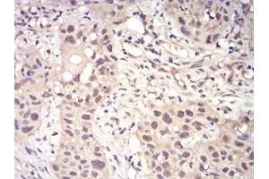 Immunohistochemical analysis of paraffin-embedded esophageal cancer tissues using RAD23A mouse mAb with DAB staining. (RAD23A anticorps  (AA 1-363))
