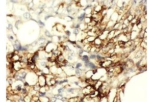 IHC-P: CD44 antibody testing of human intestinal cancer tissue