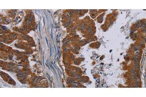 Immunohistochemistry of paraffin-embedded Human esophagus cancer tissue using NECTIN3 Polyclonal Antibody at dilution 1:40 (nectin-3 anticorps)
