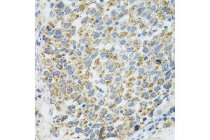 Immunohistochemistry of paraffin-embedded human lung cancer using TXN2 antibody (ABIN2560616) at dilution of 1:100 (40x lens). (TXN2 anticorps)