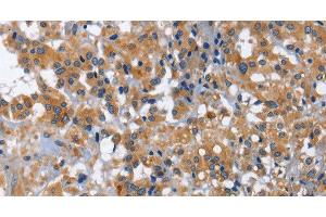 Immunohistochemistry of paraffin-embedded Human thyroid cancer using IL2RB Polyclonal Antibody at dilution of 1:30 (IL2 Receptor beta anticorps)