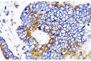 Immunohistochemistry of paraffin-embedded Human colon carcinoma using MRPL13 Polyclonal Antibody at dilution of 1:100 (40x lens). (MRPL13 anticorps)