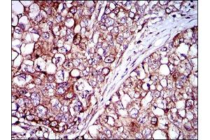Immunohistochemical analysis of paraffin-embedded lung cancer tissues using ZFP42 mouse mAb with DAB staining.