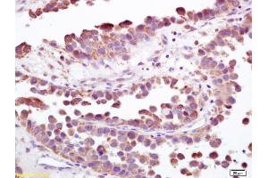 Formalin-fixed and paraffin embedded human bladder carcinoma labeled with Anti-S100-A9/MRP14/CFAG/Calgranulin B Polyclonal Antibody, Unconjugated (ABIN749288) at 1:200, followed by conjugation to the secondary antibody and DAB staining
