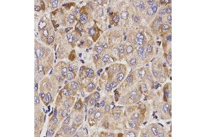 Immunohistochemistry of paraffin-embedded human liver cancer tissue using GAS2 antibody at dilution of 1:200 (x400 lens)
