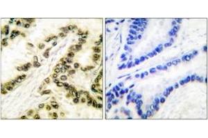Immunohistochemistry analysis of paraffin-embedded human lung carcinoma tissue, using AP-2 Antibody.