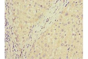 Immunohistochemistry of paraffin-embedded human liver cancer using ABIN7150741 at dilution of 1:100
