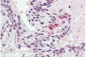Human Prostate (formalin-fixed, paraffin-embedded) stained with KLK11 antibody ABIN337038 at 5 ug/ml followed by biotinylated goat anti-rabbit IgG secondary antibody ABIN481713, alkaline phosphatase-streptavidin and chromogen. (Kallikrein 11 anticorps  (AA 68-82))