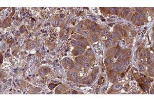 ABIN6277654 at 1/100 staining Human liver cancer tissue by IHC-P. (MLKL anticorps  (Internal Region))