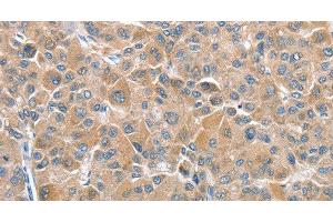 Immunohistochemistry of paraffin-embedded Human liver cancer tissue using CHMP4B Polyclonal Antibody at dilution 1:40 (CHMP4B anticorps)