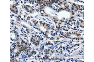 Immunohistochemistry of Human gastic cancer using ENPP3 Polyclonal Antibody at dilution of 1:80 (ENPP3 anticorps)