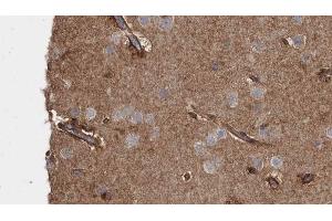 ABIN6273483 at 1/100 staining Human brain cancer tissue by IHC-P.