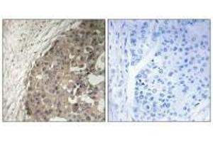 Immunohistochemistry analysis of paraffin-embedded human breast carcinoma tissue using CSGALNACT1 antibody. (CSGALNACT1 anticorps)