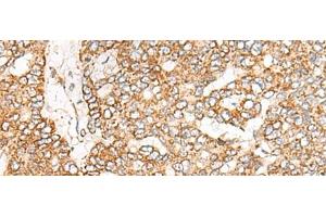 Immunohistochemistry of paraffin-embedded Human liver cancer tissue using NME4 Polyclonal Antibody at dilution of 1:45(x200) (NME4 anticorps)