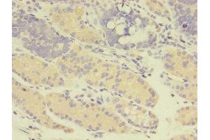 Immunohistochemistry of paraffin-embedded human gastric cancer using ABIN7166957 at dilution of 1:100