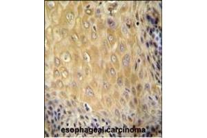 C6orf70 antibody (Center) (ABIN654987 and ABIN2844625) immunohistochemistry analysis in formalin fixed and paraffin embedded human esophageal carcinoma followed by peroxidase conjugation of the secondary antibody and DAB staining. (C6orf70 anticorps  (AA 346-375))