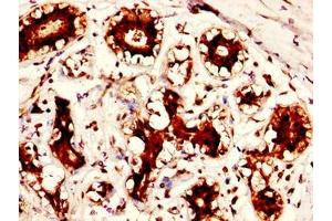 IHC image of ABIN7166389 diluted at 1:300 and staining in paraffin-embedded human breast cancer performed on a Leica BondTM system.