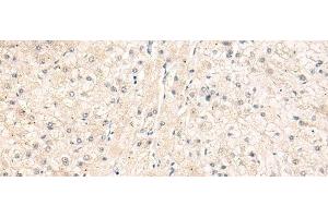 Immunohistochemistry of paraffin-embedded Human liver cancer tissue using ELP1 Polyclonal Antibody at dilution of 1:30(x200) (IKAP/p150 anticorps)