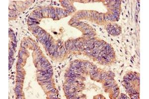 Immunohistochemistry of paraffin-embedded human colon cancer using ABIN7155869 at dilution of 1:100 (HIPK3 anticorps  (AA 841-1130))