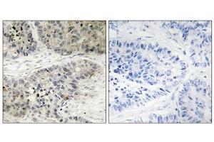 Immunohistochemistry analysis of paraffin-embedded human lung carcinoma tissue, using MAPK15 antibody.