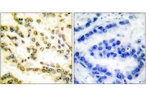 Immunohistochemistry analysis of paraffin-embedded human lung carcinoma tissue, using Lamin A (Cleaved-Asp230) Antibody.