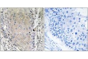Immunohistochemistry analysis of paraffin-embedded human lung carcinoma tissue, using CBLN3 Antibody. (CBLN3 anticorps  (AA 131-180))