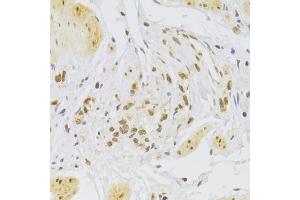 Immunohistochemistry of paraffin-embedded human stomach using Slug Antibody (ABIN6127298, ABIN6148181, ABIN6148183 and ABIN6217314) at dilution of 1:100 (40x lens). (SLUG anticorps  (AA 126-268))