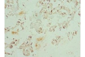 Immunohistochemistry of paraffin-embedded human bladder cancer using ABIN7148657 at dilution of 1:100