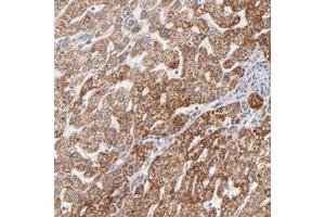 Immunohistochemical staining (Formalin-fixed paraffin-embedded sections) of human liver with TIMM8A polyclonal antibody  shows strong cytoplasmic positivity in hepatocytes. (TIMM8A/DDP anticorps)