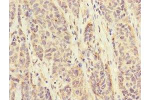 Immunohistochemistry of paraffin-embedded human ovarian cancer using ABIN7152671 at dilution of 1:100