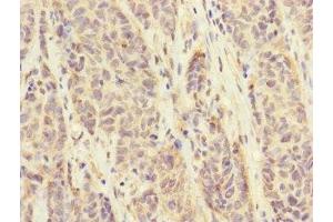 Immunohistochemistry of paraffin-embedded human ovarian cancer using ABIN7152671 at dilution of 1:100 (FCRL6 anticorps  (AA 20-307))