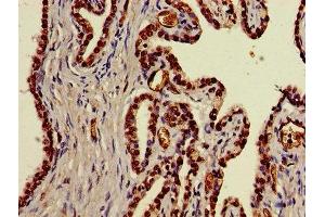 Immunohistochemistry of paraffin-embedded human prostate cancer using ABIN7170614 at dilution of 1:100 (DDX39B anticorps  (AA 2-251))