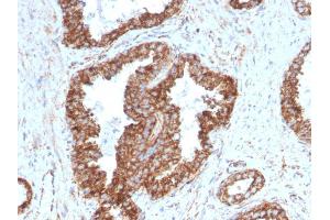 Formalin-fixed, paraffin-embedded human Prostate Carcinoma stained with PMEPA1 Mouse Monoclonal Antibody (PMEPA1/2698). (PMEPA1 anticorps)