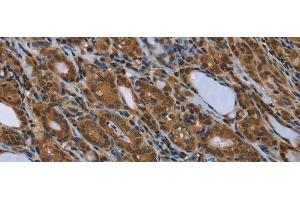 Immunohistochemistry of paraffin-embedded Human thyroid cancer using SMAD4 Polyclonal Antibody at dilution of 1/40 (SMAD4 anticorps)