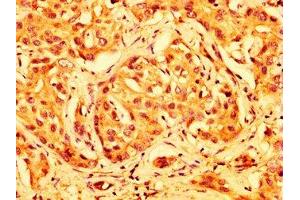 IHC image of ABIN7144938 diluted at 1:500 and staining in paraffin-embedded human liver cancer performed on a Leica BondTM system.