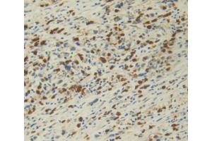 DAB staining on IHC-P; Samples: Human Stomach Cancer Tissue.