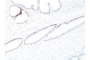 Formalin-fixed, paraffin-embedded human Prostate Carcinoma stained with Cytokeratin, HMW Mouse Monoclonal Antibody (34BE12).