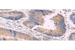 Immunohistochemistry of paraffin-embedded Human colorectal cancer tissue using NIPSNAP1 Polyclonal Antibody at dilution of 1:50(x200) (NIPSNAP1 anticorps)