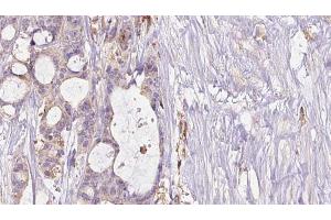 ABIN6267460 at 1/100 staining Human liver cancer tissue by IHC-P.